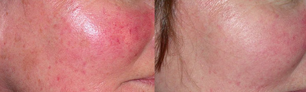 luce pulsata rosacea