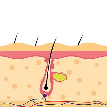 Sense Laser preparazione