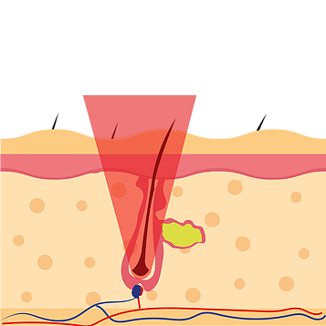 Sense Laser trattamento