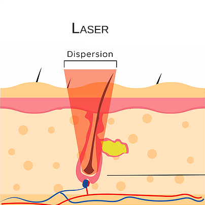 Sense Laser funzionamento